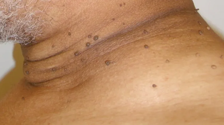 Acanthosis Nigricans Penyebab Lipatan Kulit Menghitam dan Berkutil