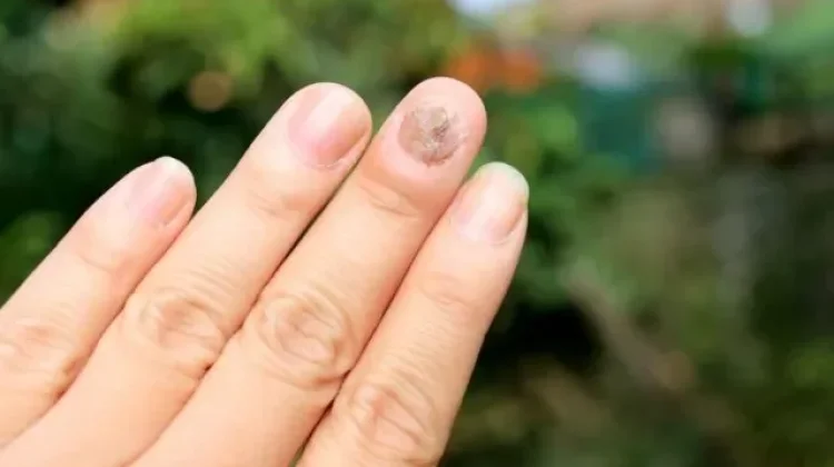 Waspadai Perubahan pada Kuku Sebagai Sinyal Gangguan Kesehatan