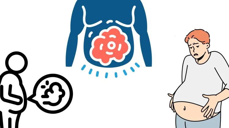 Bloating Salah Satu Penyebab Perut Terlihat Buncit