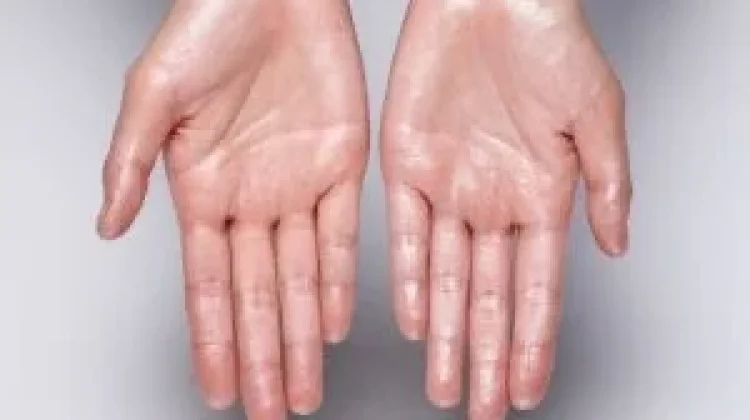 Hiperhidrosis, Kondisi Keringat Berlebih yang Perlu Diwaspadai