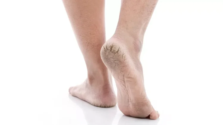 Kondisi Tumit Kaki Pecah-Pecah, Ketahui Bahaya dan Cara Mengatasinya