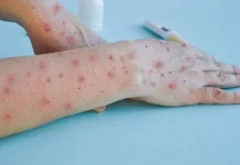Waspada Cacar Air di Musim Pancaroba
