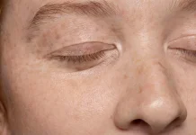 Perempuan 30+ Wajib Tahu, Kenapa Flek Hitam Mulai Muncul di Wajah
