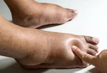 Penyebab Kaki Bengkak dan Cara Mengatasinya