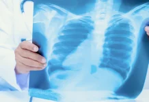 Gunakan X-Ray Portable, Sulsel Percepat Temukan Kasus TBC