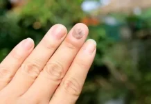 Waspadai Perubahan pada Kuku Sebagai Sinyal Gangguan Kesehatan