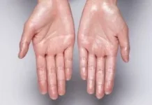 Hiperhidrosis, Kondisi Keringat Berlebih yang Perlu Diwaspadai
