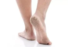 Kondisi Tumit Kaki Pecah-Pecah, Ketahui Bahaya dan Cara Mengatasinya