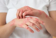 Bukan Hanya Anak-anak, Campak Bisa Menyerang Orang Dewasa