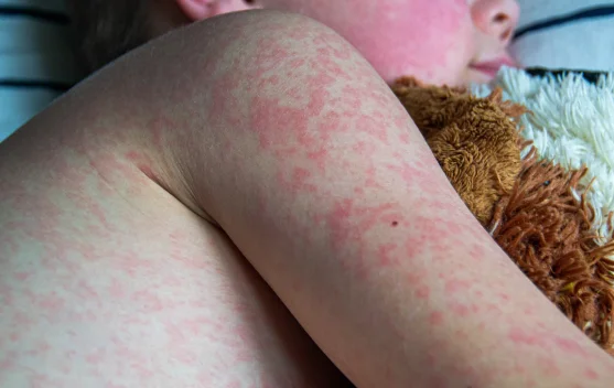 Kenali Gejala Campak dan Pentingnya Vaksinasi Bagi Anak