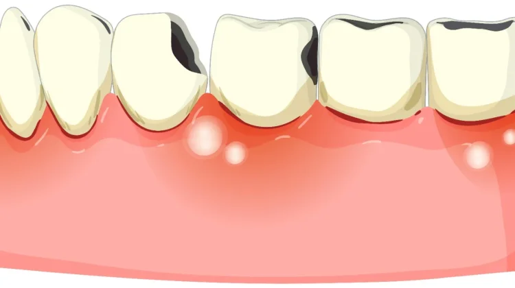 Waspada Gusi Berdarah, Tanda Awal Periodontitis