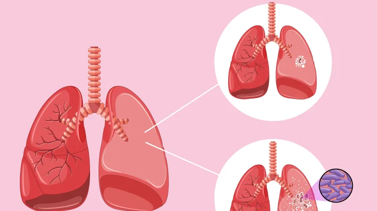 Batuk Tak Kunjung Sembuh? Waspada TBC, Deteksi Dini Jadi Kunci Kesembuhan