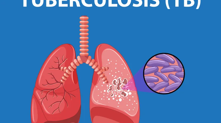 TBC Bisa Sembuh Total, Dokter Tegaskan Pengobatan Tidak Bisa Diganti Herbal