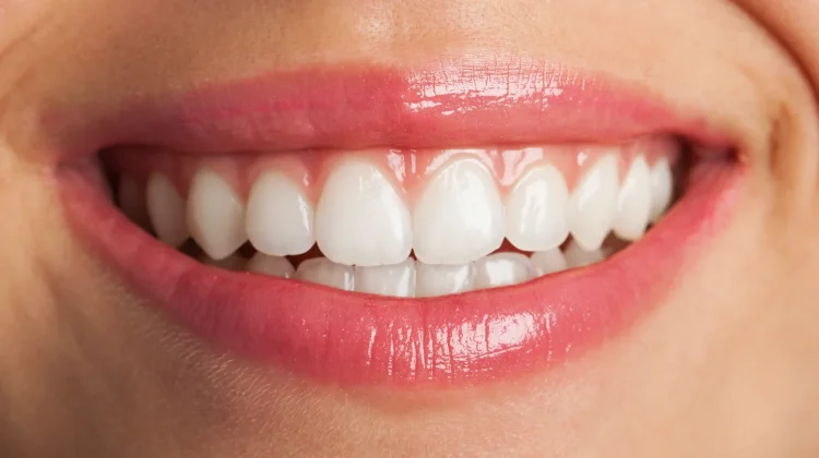 Bleaching vs Veneer: Kenali Perbedaan Proses, Ketahanan, dan Biayanya