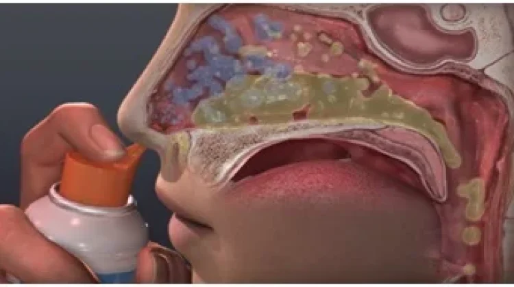 Cuci Hidung Anak Aman, Asalkan Dilakukan dengan Tepat