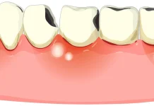 Waspada Gusi Berdarah, Tanda Awal Periodontitis