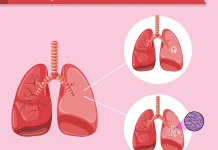 Batuk Tak Kunjung Sembuh? Waspada TBC, Deteksi Dini Jadi Kunci Kesembuhan