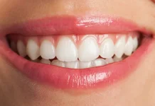 Bleaching vs Veneer: Kenali Perbedaan Proses, Ketahanan, dan Biayanya