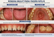 Rongga Mulut Bisa Menjadi Petunjuk Awal Berbagai Penyakit