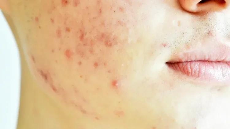 Buah “Skincare dari Dalam” Buat Lawan Jerawat Membandel