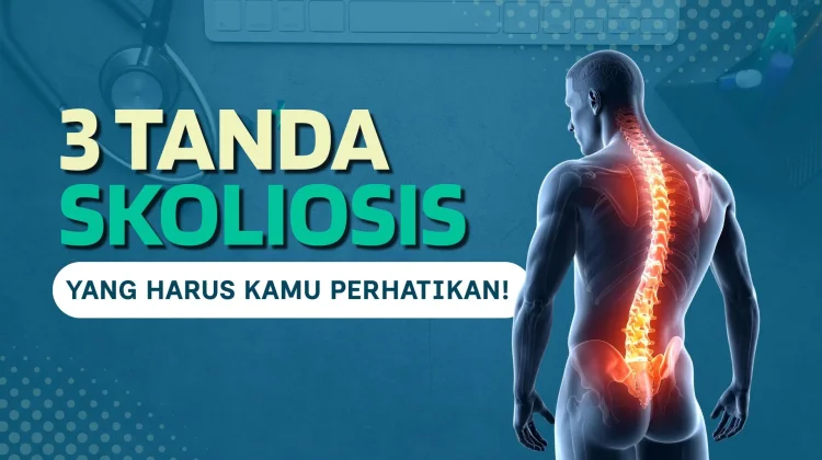 Tiga Tanda Skoliosis yang Wajib Diwaspadai sejak Dini