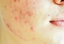 Buah “Skincare dari Dalam” Buat Lawan Jerawat Membandel