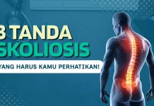 Tiga Tanda Skoliosis yang Wajib Diwaspadai sejak Dini