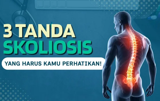 Tiga Tanda Skoliosis yang Wajib Diwaspadai sejak Dini