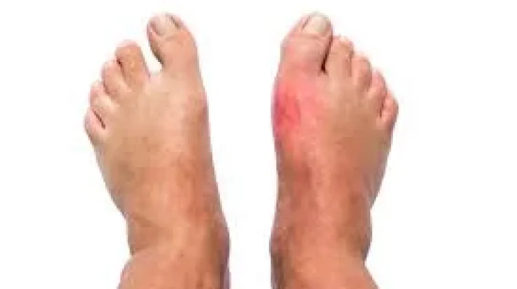 Jangan Anggap Sepele Kaki Bengkak, Tanda Penyakit Serius