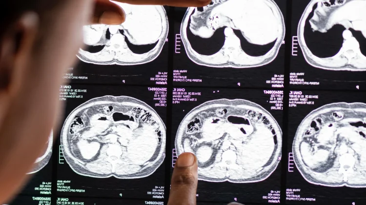 Waspada, Gejala Tumor Otak Anak Kerap Dianggap Keluhan Biasa