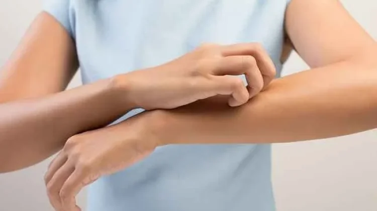 Berbagai Cara Menghilangkan Bekas Gigitan Nyamuk