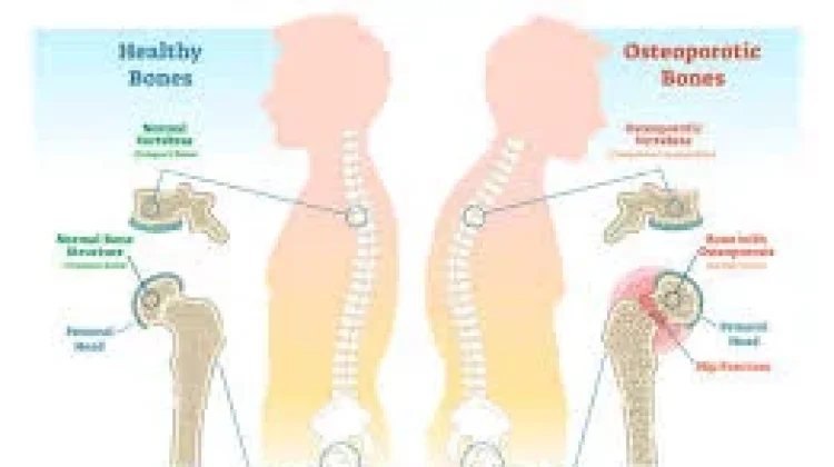 Gaya Hidup Sehat Kunci Pengeroposan Tulang sejak Dini