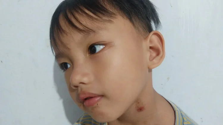 Penyebab Bisul pada Anak dan Faktor Risiko Utamanya