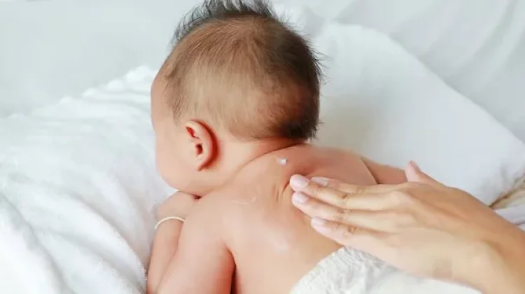 Kenali Masalah Kulit Bayi dan Cara Mengatasinya