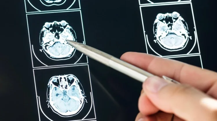 Dokter Imbau Masyarakat Rutin Skrining Otak