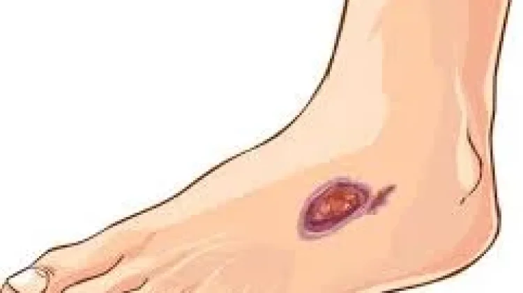 Bahaya Luka Diabetes, Infeksi Kecil yang Bisa Jadi Fatal