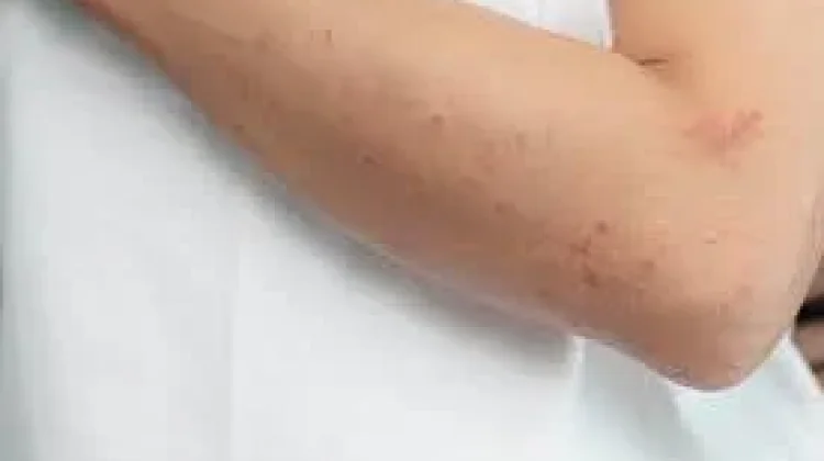 Waspada, Gatal Kulit Bisa Jadi Gejala Awal Diabetes