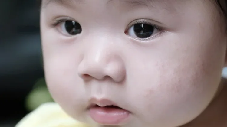 Kenali Pitiriasis Alba Penyebab Bercak Putih pada Anak