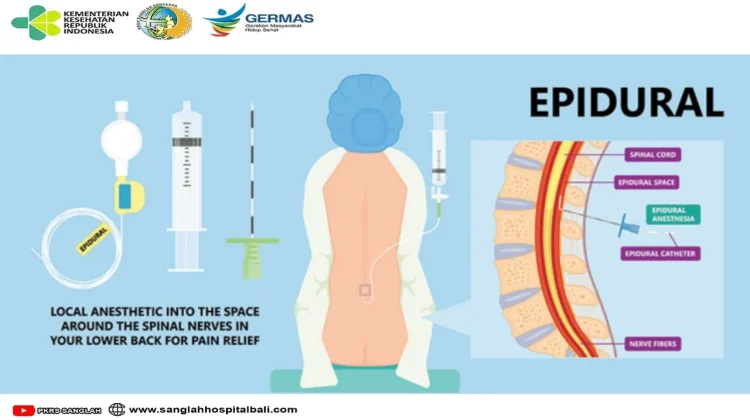 Mengenal Lebih Dekat Epidural Anestesia