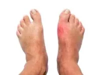 Jangan Anggap Sepele Kaki Bengkak, Tanda Penyakit Serius