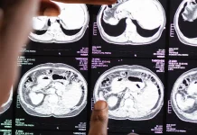 Waspada, Gejala Tumor Otak Anak Kerap Dianggap Keluhan Biasa