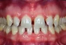 Mengenal Diastema dan Solusinya untuk Meningkatkan Percaya Diri