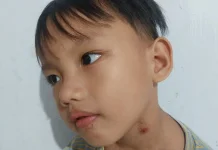 Penyebab Bisul pada Anak dan Faktor Risiko Utamanya