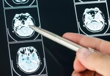 Dokter Imbau Masyarakat Rutin Skrining Otak