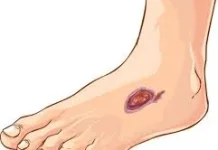 Bahaya Luka Diabetes, Infeksi Kecil yang Bisa Jadi Fatal