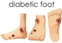 Kenali Ciri-Ciri Luka Diabetes dengan Luka Biasa
