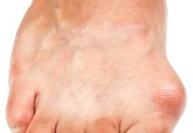 Mengenal Gout Penyakit Asam Urat