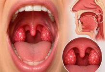 Kapan Amandel Harus Dioperasi? Ini Penjelasan Dokter THT