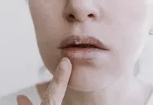 Waspadai Gejala Bibir Kering agar Tidak Bertambah Parah