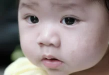 Kenali Pitiriasis Alba Penyebab Bercak Putih pada Anak